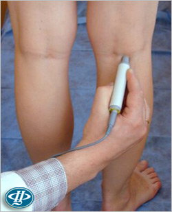 Ультразвукова доплерографія варікозу нижньої кінцівки