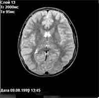 Магнітно-резонансний томограф «Юнітом» - головний мозок