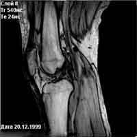 Магнітно-резонансний томограф «Юнітом» - колінний суглоб
