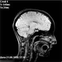 Магнітно-резонансний томограф «Юнітом» - голова