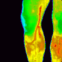 Термограма колінного суглобу